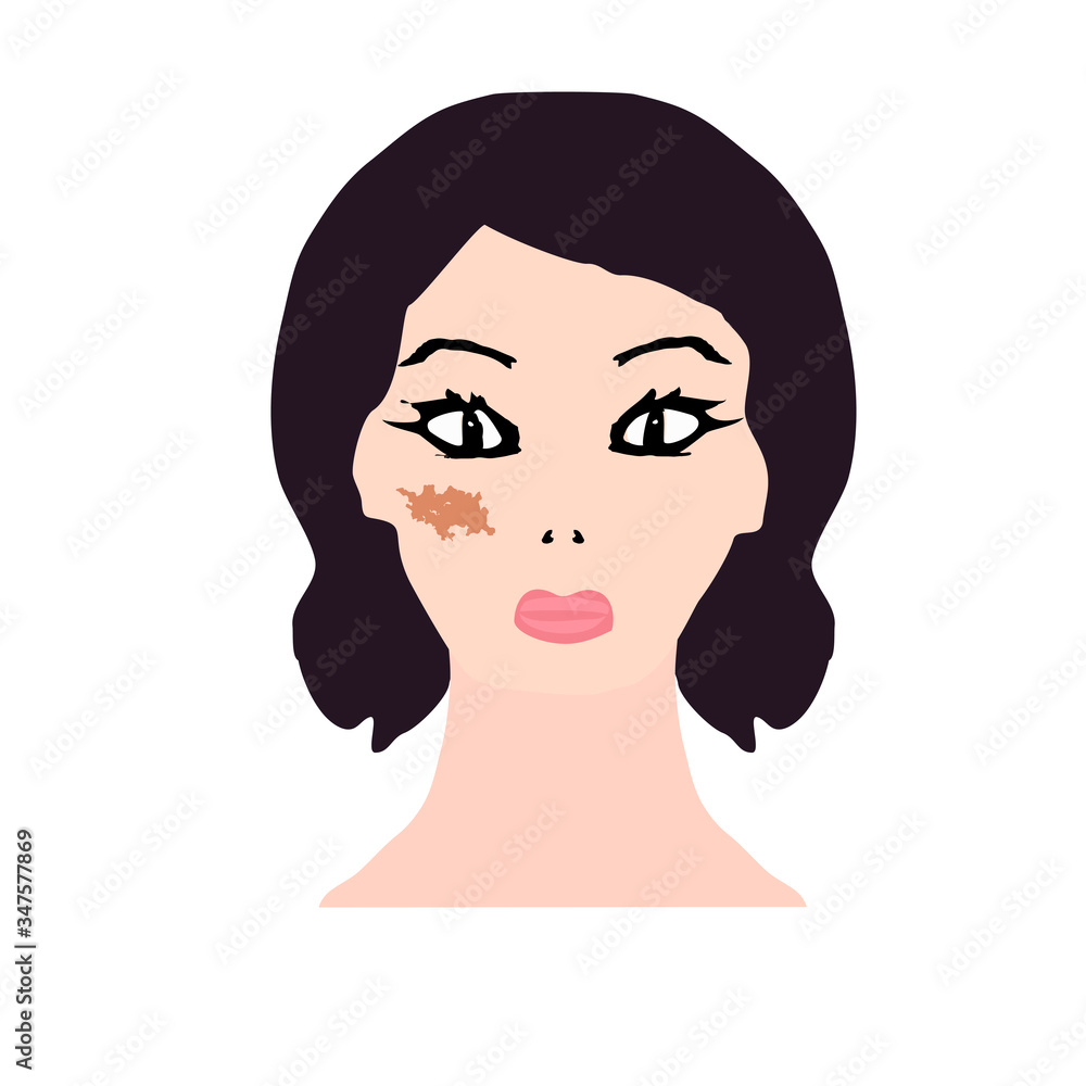 Pigmentation on the skin. A pigmented spot on the skin of the face. Vector illustration Pigmentation on the skin. A pigmented spot on the skin of the face. Vector illustration