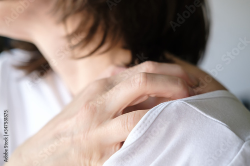 Foto Female hand scratch itchy skin on his shoulder.