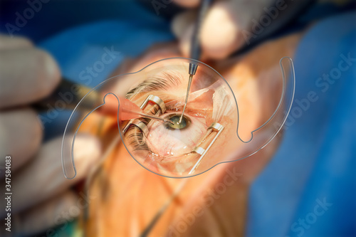 intraocular lens iol cataract ophthalmology