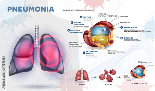 Pneumonia explained info poster, body immune response, human lungs and detailed alveolus anatomy illustration.