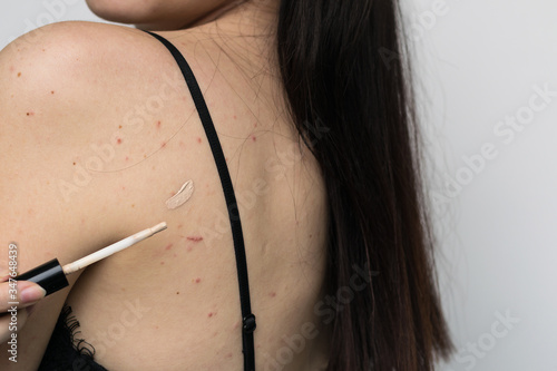 problematic skin of the back and face of a young girl, an attempt to gloss over with a corrective agent. Acne on the shoulders of a woman, a cosmetic masking agent. Life with dermatological problems