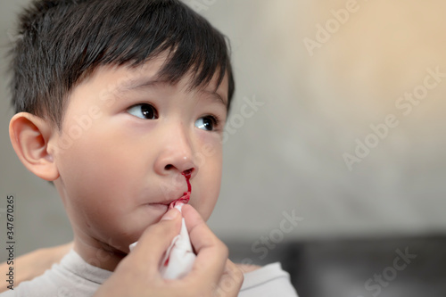 Portrait of cute Asian ethnic child having nosebleed,The concept of first aid for nosebleeds. © Patcharin