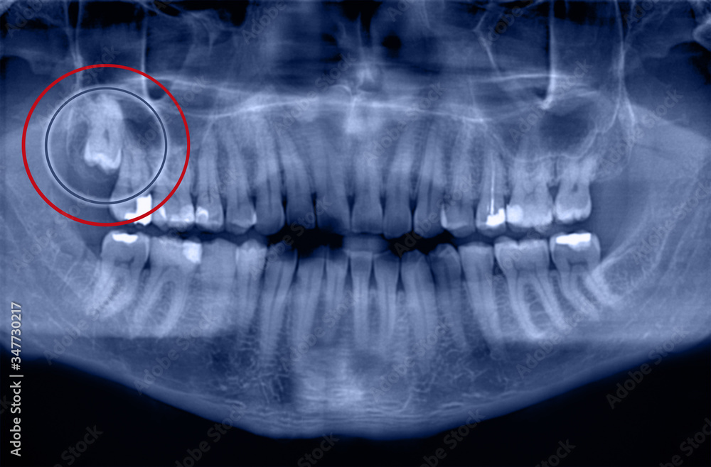 Panoramic dental xray of a mouth left and right side Growing Wisdom