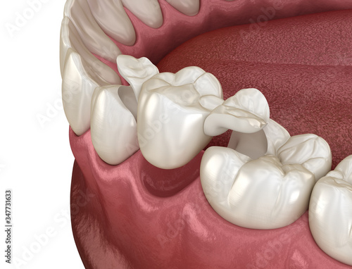 Maryland bridge made from ceramic, premolar tooth recovery. Medically accurate 3D illustration of dental concept