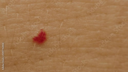 red moles on the patient s skin, hemangioma, angioneuromas, copy space, medical. Birthmark