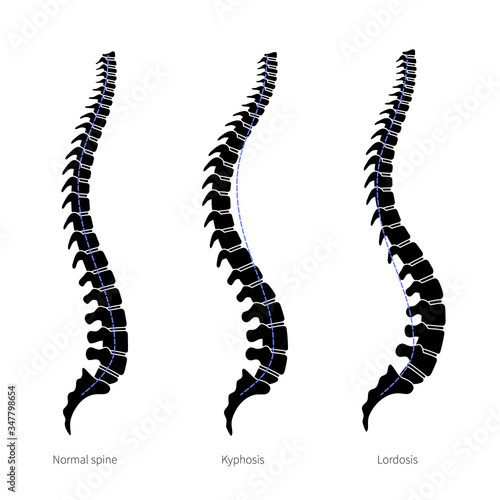 Kyphosis, lordosis flat vector illustration.