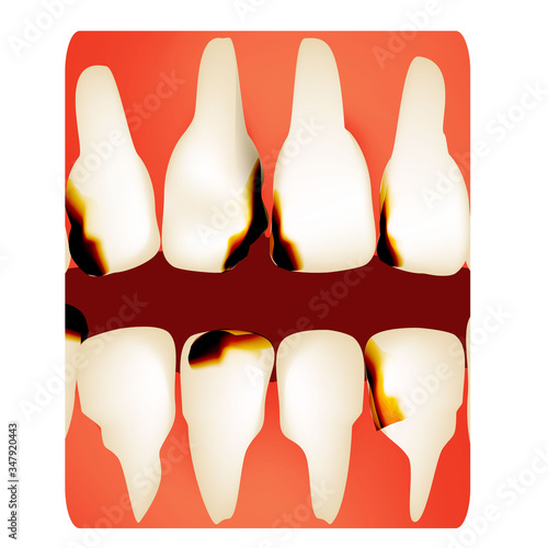 Dental caries. tooth decay. Caries infographics. Vector illustration on isolated background.