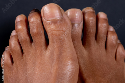 Hammer toe on the second toe of a mixed-race woman in front of black background. Concept for medical themes. Close-up.