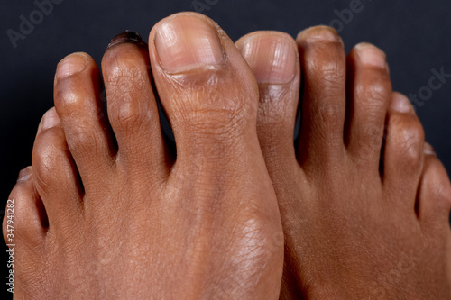 Hammer toe on the second toe of a mixed-race woman in front of black background. Concept for medical themes. Close-up. photo