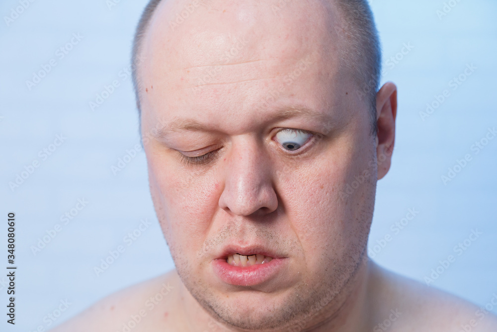 Portrait of a bald man who bulged his eyes. Portrait of a bald man who bulged his eyes.