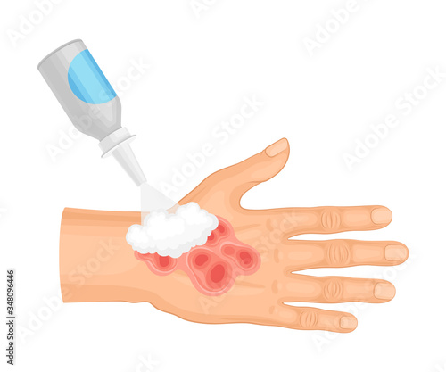 First Aid for Hand with Ambustion or Burn on the Skin Vector Illustration