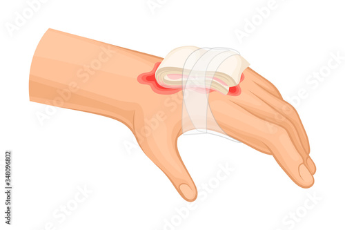 First Aid for Hand with Ambustion or Burn on the Skin Vector Illustration