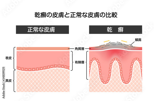 乾癬と健康な肌の比較　断面図イラスト 