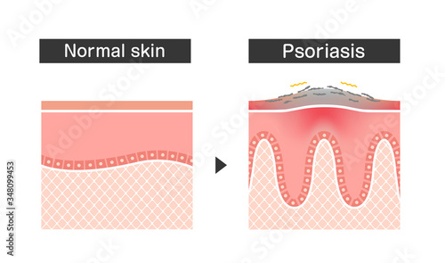 Cross section of psoriasis and normal skin / flat vector illustration