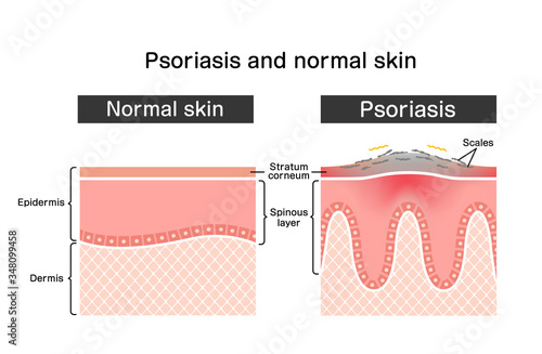 Cross section of psoriasis and normal skin / flat vector illustration