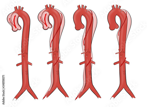 Aortic dissection. Ilustration of four types of aortic dissection photo