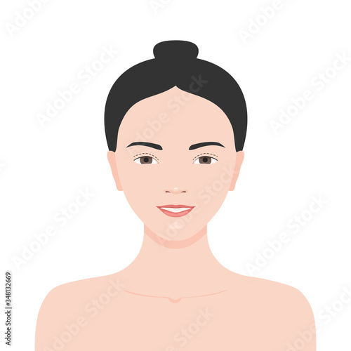 Double eyelid surgery