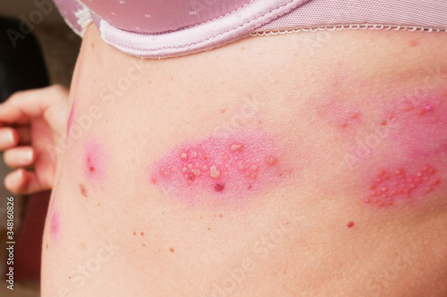 skin rash treatment on woman body. Shingles, Disease, Herpes zoster, varicella-zoster virus. skin rash and blisters on body photo