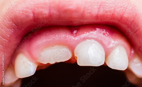 Permanent and milk teeth on a child. One tooth is missing. Gums are swollen. On some teeth there is some dental plaque.