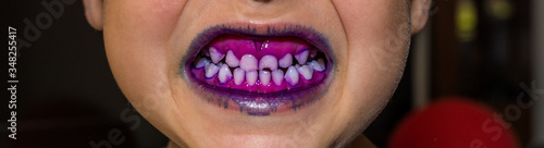 Dental plaque pill to indentefy teeth plaque. Blue colour shows plaque less than 24 hour old and purple shows plaque more than 24 hour old.