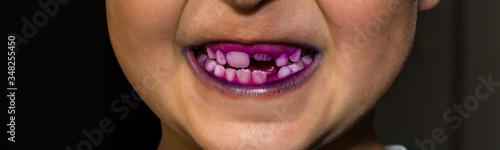 Dental plaque pill to indentefy teeth plaque. Blue colour shows plaque less than 24 hour old and purple shows plaque more than 24 hour old.
