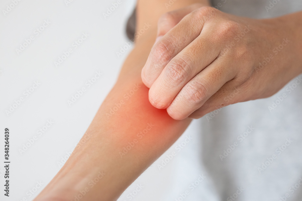Young asian man itching and scratching on arm from itchy dry skin eczema dermatitis Young asian man itching and scratching on arm from itchy dry skin eczema dermatitis