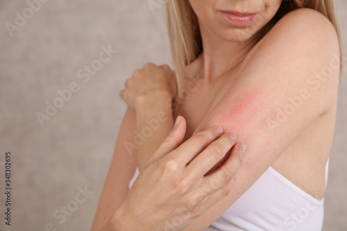 Woman Scratching an itch close up . Sensitive Skin, Food allergy symptoms, Irritation