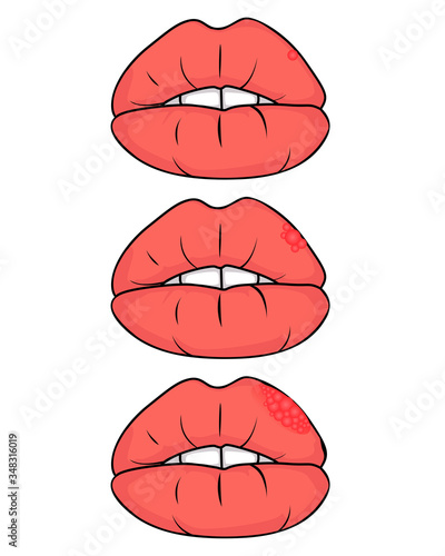 herpes simplex virus on the lips