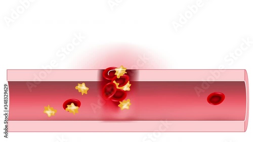 Hemostasis. Red blood cells and platelets in the blood vessel. Basic steps of wound healing process. 2D animation. photo