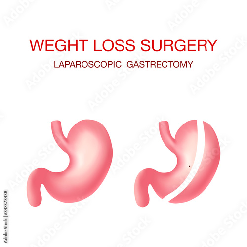 Vertical Sleeve Gastrectomy medical vector illustration diagram with stomach surgical cut. Bariatric surgery with a reduction of the size of the stomach for weight loss and loss of body weight.