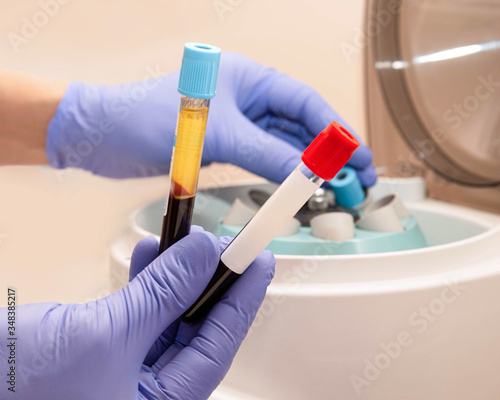Hands of a nurse in gloves take out two test tubes with blood plasma from a centrifuge for prp therapy. Test tubes close-up.