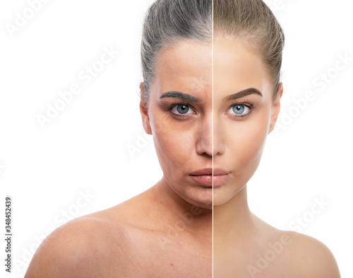 Beautiful young girl with half face of old tired woman with wrinkles, dark circles, comedones and and gray hair. Anti-aging, beauty treatment, aging and youth, lifting, skincare, hydration, surgery