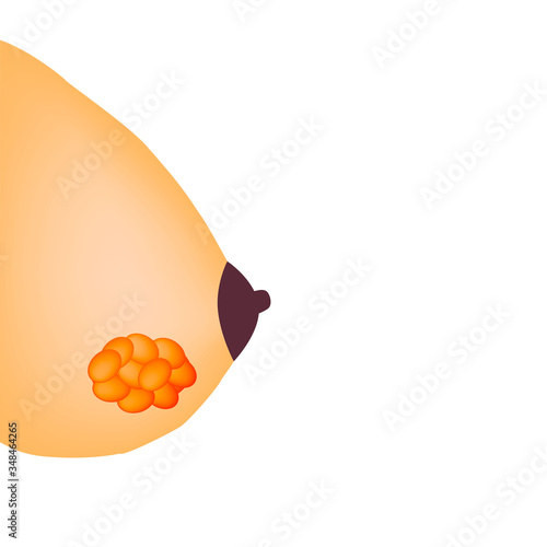 Fibrooadenomatosis in the mammary gland. World Breast Cancer Day. Vector illustration on isolated background