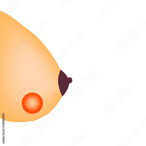 Abscess in the mammary gland. World Breast Cancer Day. Vector illustration on isolated background