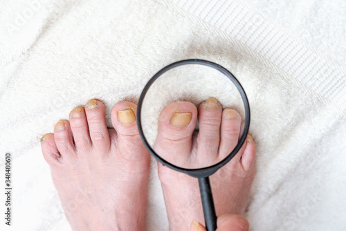 Close up image of Dermatologist checking with magnifying glasses feet toe nail.examination the nail on the presence of the fungus, eczema.White background. 