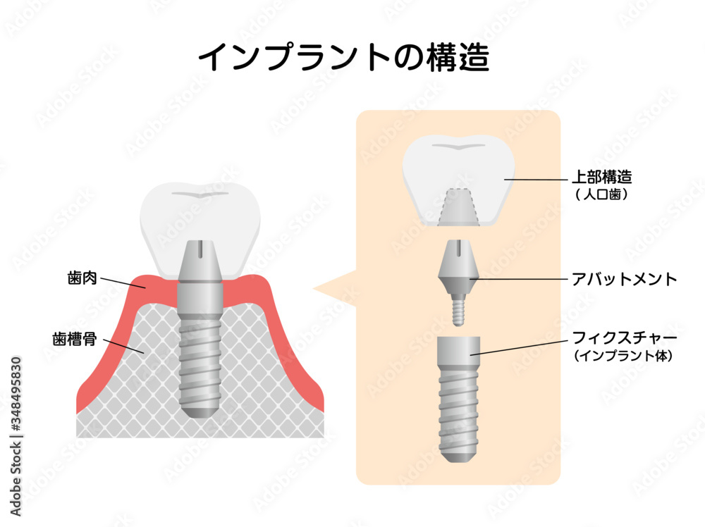 インプラントの仕組み 構造 断面図イラスト Stock Vektorgrafik Adobe Stock インプラントの仕組み 構造 断面図イラスト Stock Vektorgrafik Adobe Stock