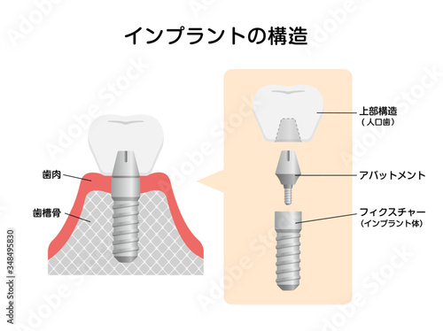 インプラントの仕組み・構造　断面図イラスト 