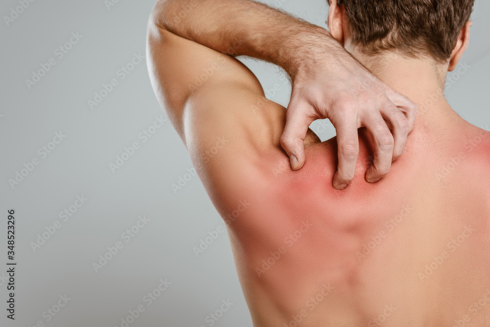 Partial view of man scratching skin with allergy isolated on grey Partial view of man scratching skin with allergy isolated on grey