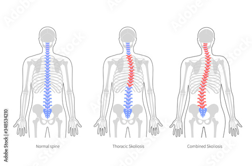 Scoliosis flat vector illustration