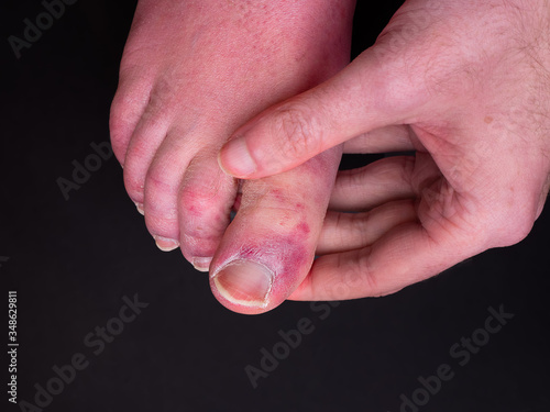 A white man holding his toes, showing what looks like a rash with red blotchy skin. A common side effect of Covid-19 often referred to as 