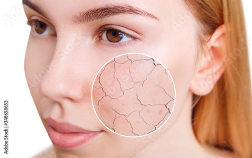 Young woman with zoom circle shows dry facial skin before moistening. Skincare concept.