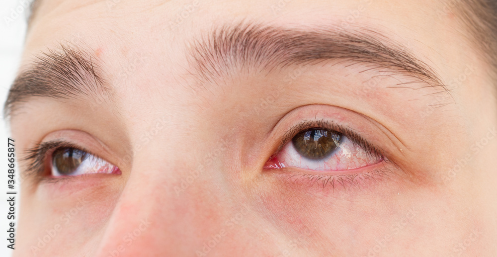 Obraz premium Close up red eyes of teenage girl with conjunctivitis or allergies
