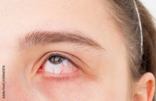 Fototapeta Naklejka Na Ścianę i Meble -  Close up red eye of teenage girl with conjunctivitis or allergies