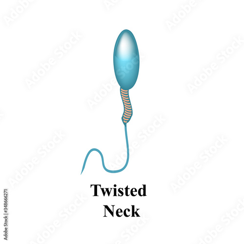 Pathological forms of sperm in the ejaculate. Male infertility Oligospermia. Spermogram. Sperm defects. Infographics. Vector illustration on isolated background.
