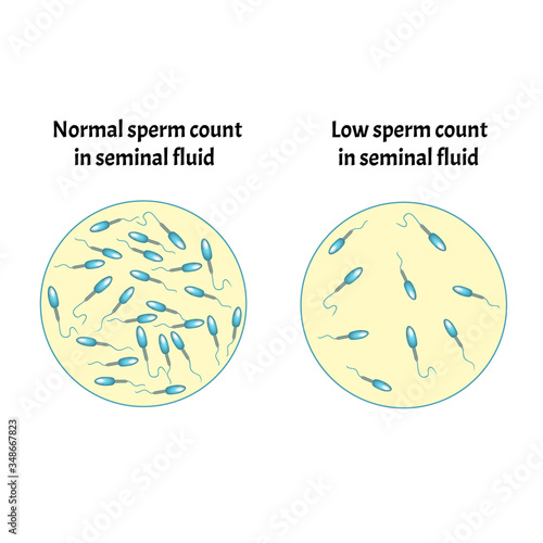 Low sperm count in seminal fluid. Low abundance of sperm in the ejaculate. Male infertility Oligospermia. Spermogram. pathology types. Sperm defects. structure of the sperm. Infographics Vector.