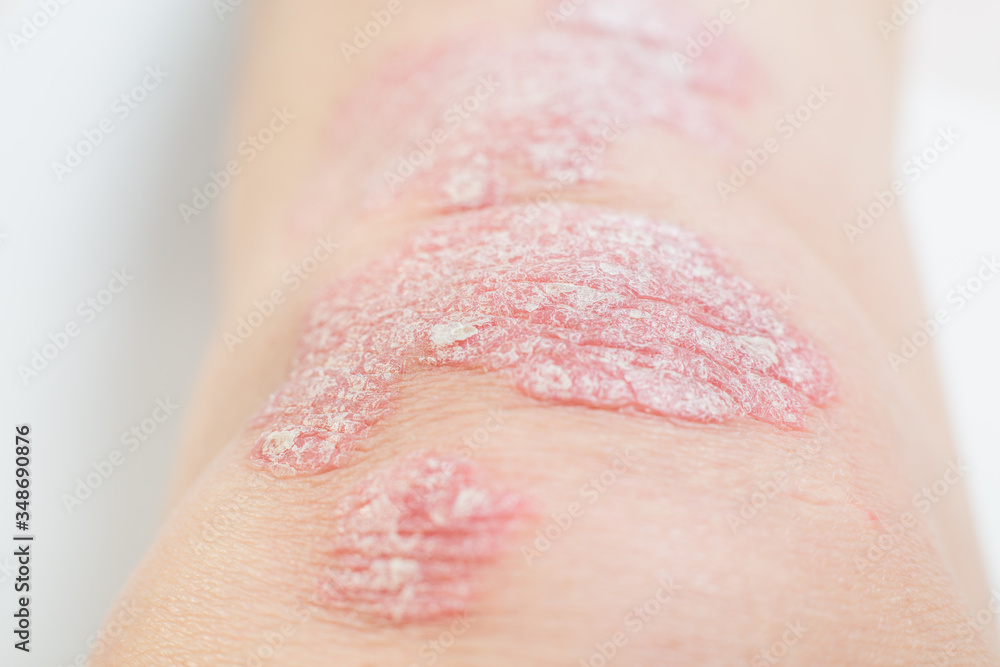 Acute psoriasis on the knees is an autoimmune incurable dermatological