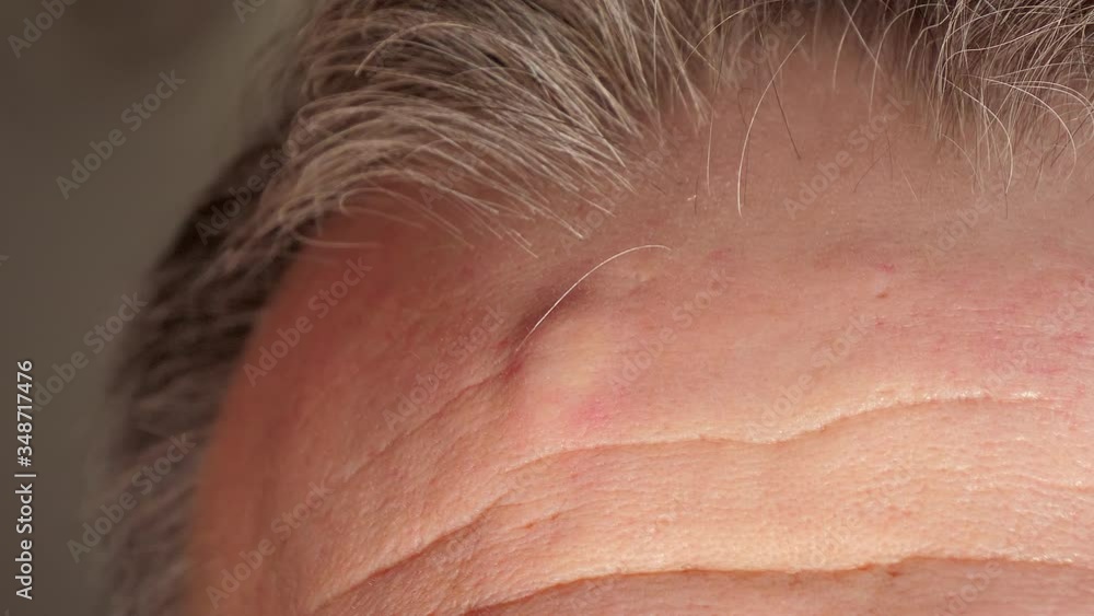 A close up look of the forehead of the man with the pimples A close up look of the forehead of the man with the pimples