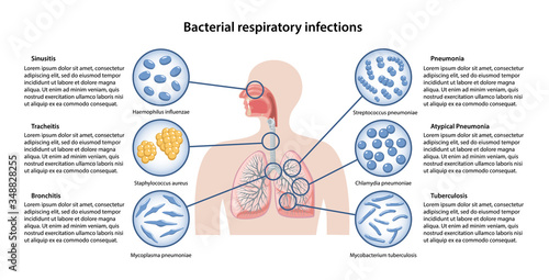 Page template with image of bacteria and description of basic bacterial respiratory infections: sinusitis, tracheitis, bronchitis, pneumonia, tuberculosis. Vector illustration in flat style