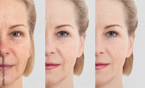 Face without makeup. Middle age close up woman face before after cosmetic. Skin care for wrinkled face. Before-after anti-aging facelift treatment. Facial skincare and contouring.