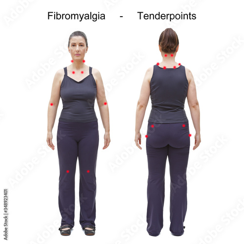 The 18 tender or trigger points of fibromyalgia indicated by red spots on the body of an woman, rear and frontal view photo